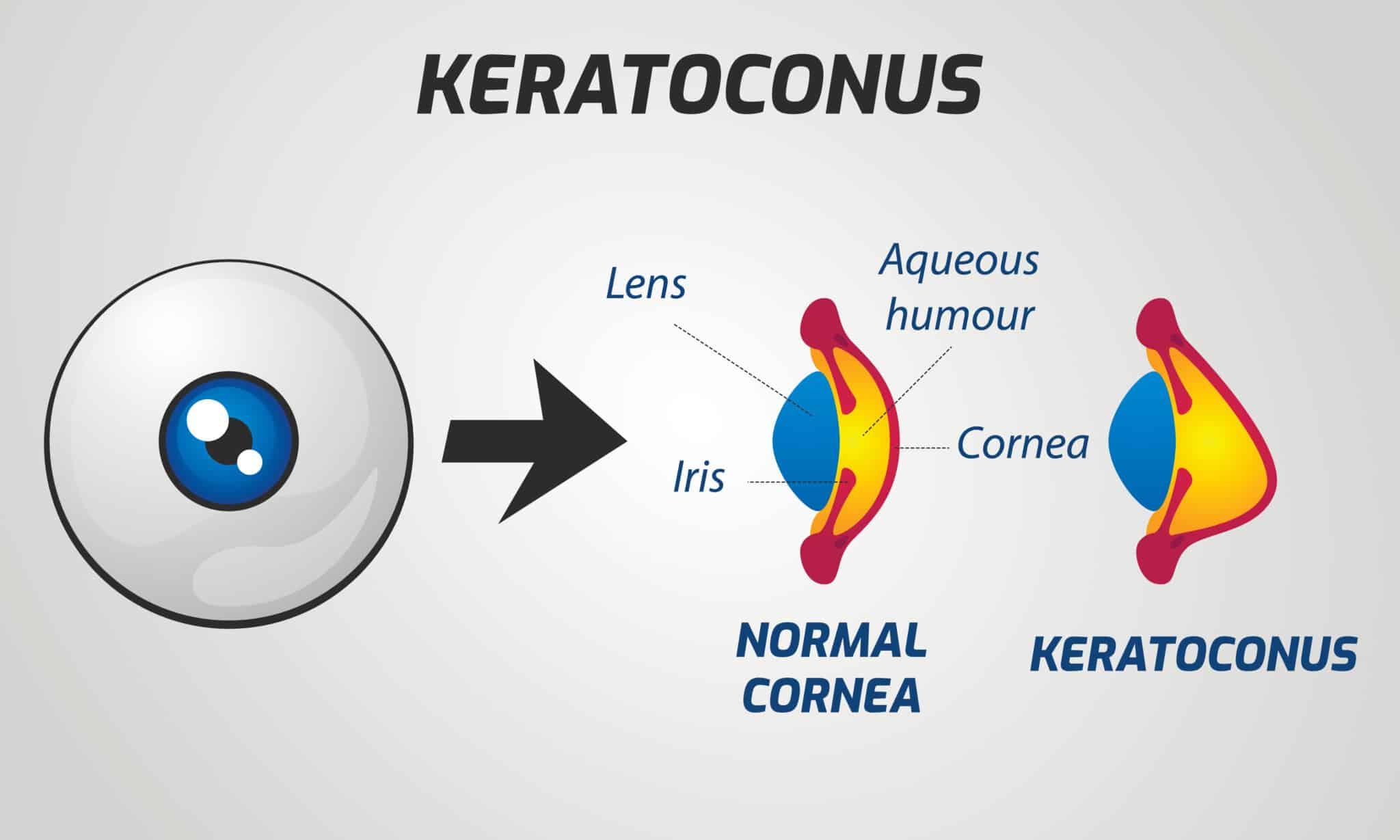What Is Keratoconus Clear Advantage
